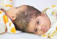 تحليل نجاح فصل التوأم الملتصق الإريتري «أسماء وسمية»