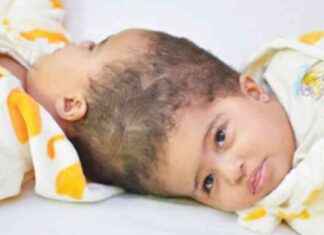 تحليل نجاح فصل التوأم الملتصق الإريتري «أسماء وسمية»