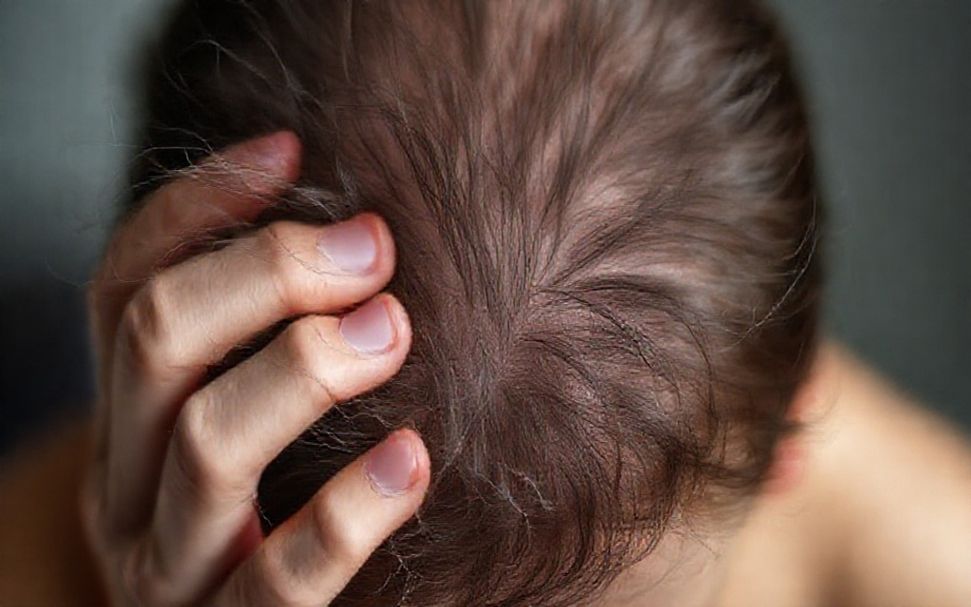 التساقط الشديد للشعر: كيف تعرف إذا كان لديك مشكلة صحية*