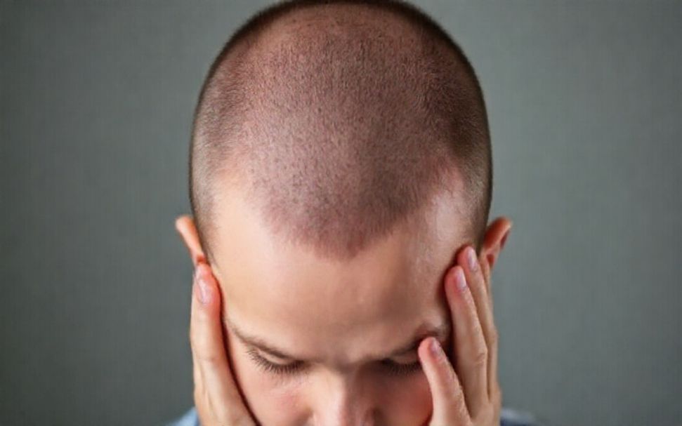 كيف يمكن تعزيز نمو الشعر بعد الثعلبة البقعية؟*