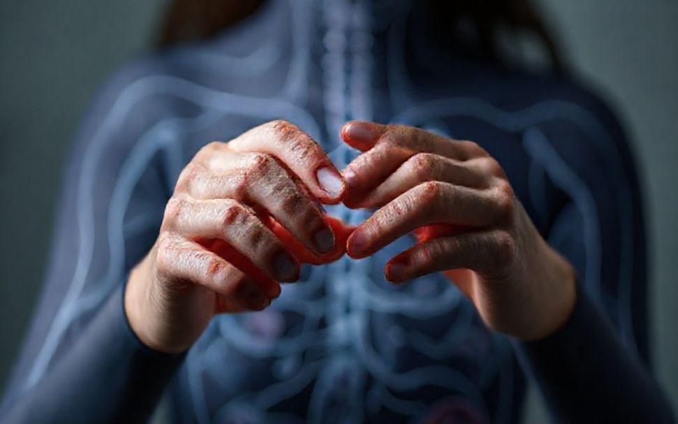 كيفية علاج الأنيميا ونقص الحديد: الأعراض والعلاجات الفعالة